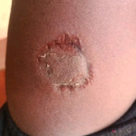 Did You Know That Human Bites Could Be More Dangerous Than Animal Bites?